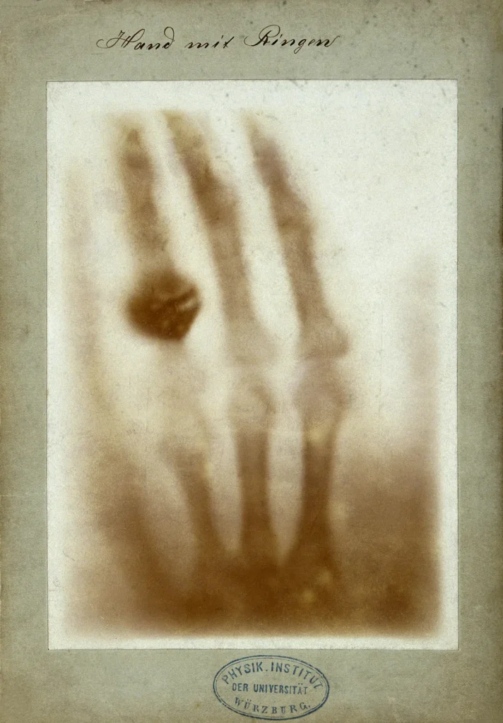 Первый рентгеновский снимок руки Анны Берты Рентген с кольцом, 1895 год